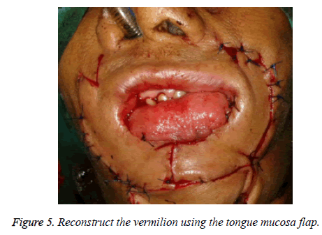 biomedres-mucosa-flap