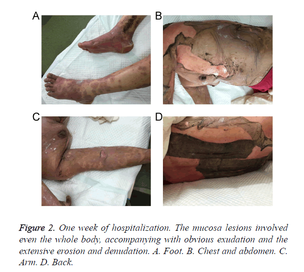 biomedres-mucosa-lesions