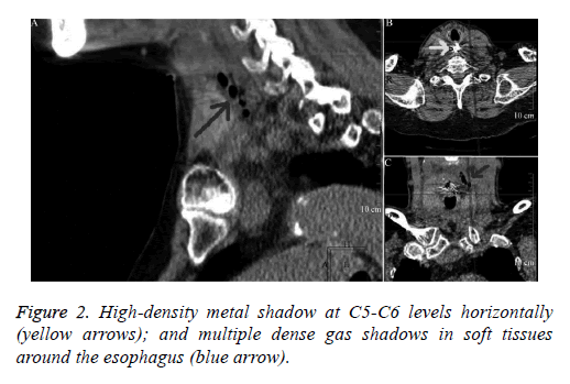 Swallowed chicken bone stuck in esophagus