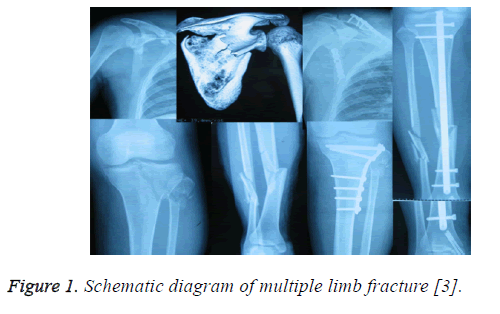 biomedres-multiple-limb-fracture