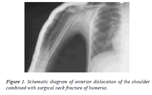 biomedres-neck-fracture