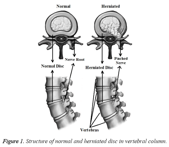 biomedres-normal-herniated-disc