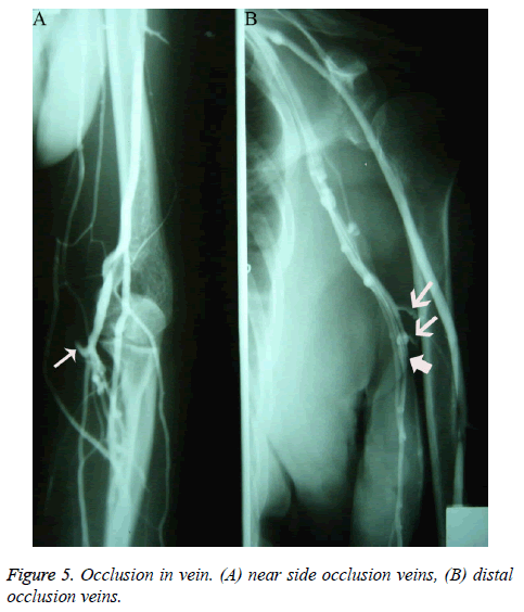 biomedres-occlusion-veins