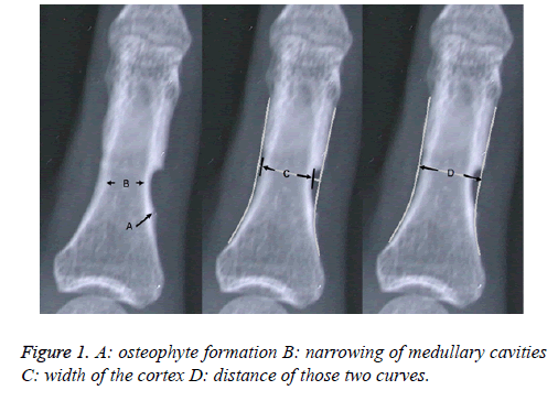 biomedres-osteophyte-distance