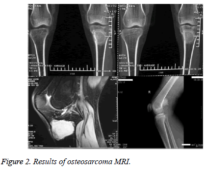 biomedres-osteosarcoma