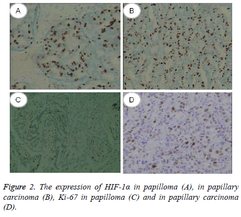 biomedres-papillary-carcinoma