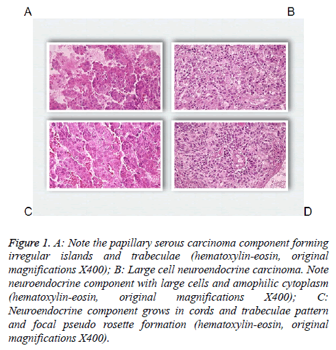 biomedres-papillary-serous