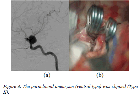 biomedres-paraclinoid-aneurysm