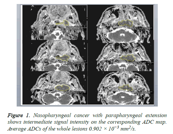 biomedres-parapharyngeal-extension