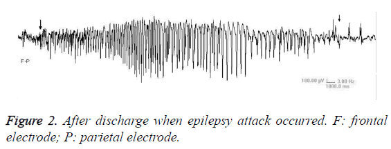 biomedres-parietal-electrode