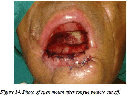 biomedres-pedicle-cut