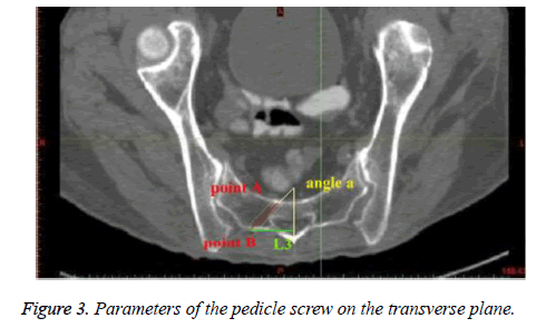 biomedres-pedicle-screw