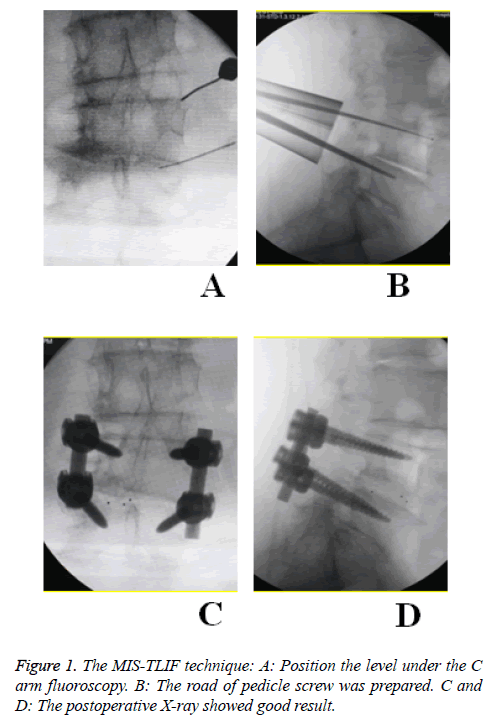 biomedres-pedicle-screw