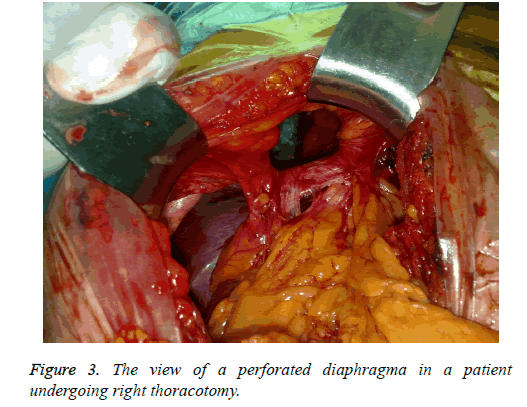 biomedres-perforated-diaphragma
