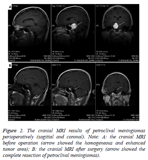 biomedres-petroclival-meningiomas