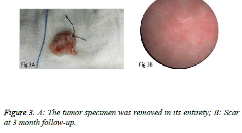 biomedres-pin-tumor-wall