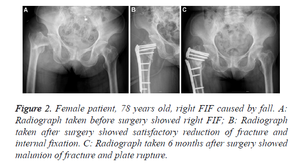 biomedres-plate-rupture