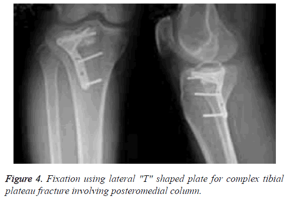 biomedres-plateau-fracture-posteromedial