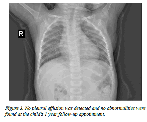 biomedres-pleural-effusion