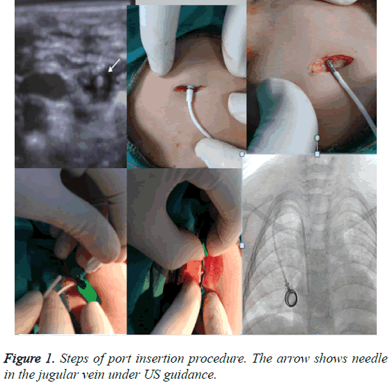 biomedres-port-insertion-procedure