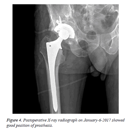 biomedres-position-prosthesis