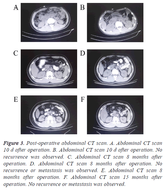 biomedres-post-operative-abdominal