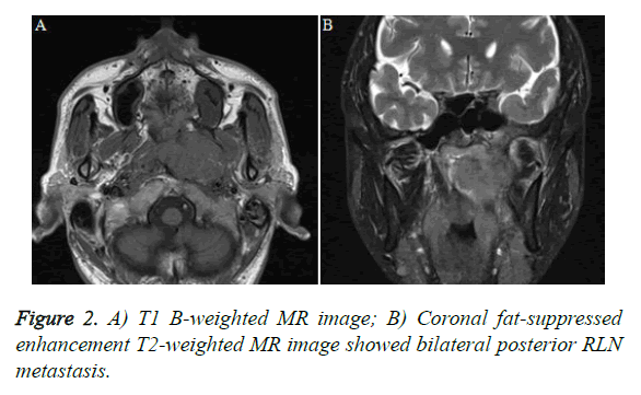 biomedres-posterior-RLN