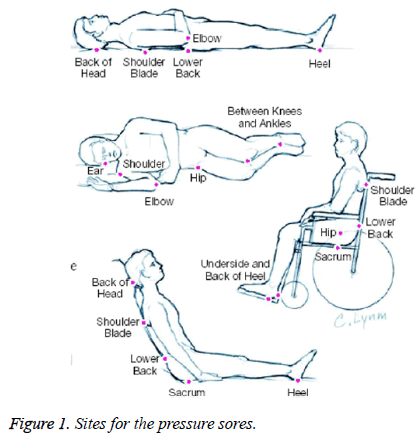 biomedres-pressure-sores