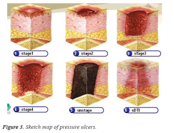 biomedres-pressure-ulcers