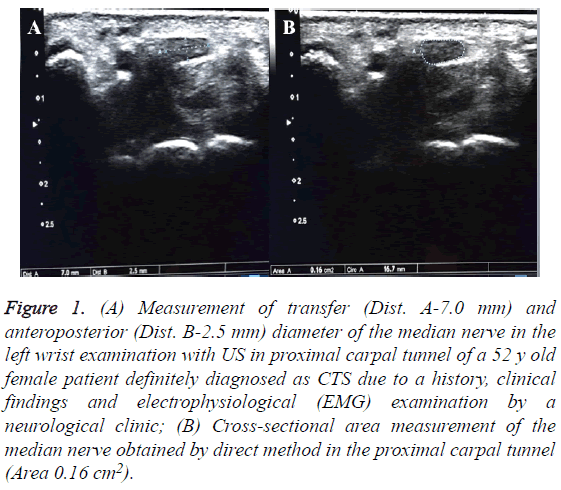 biomedres-proximal-carpal-tunnel