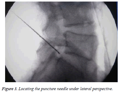 biomedres-puncture-lateral