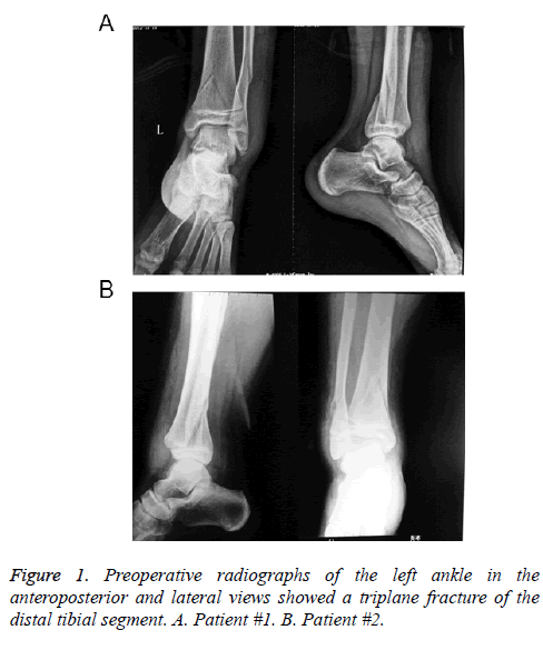 Extra-Caliber (carbon fiber) Radiolucent Tibia/Ankle System