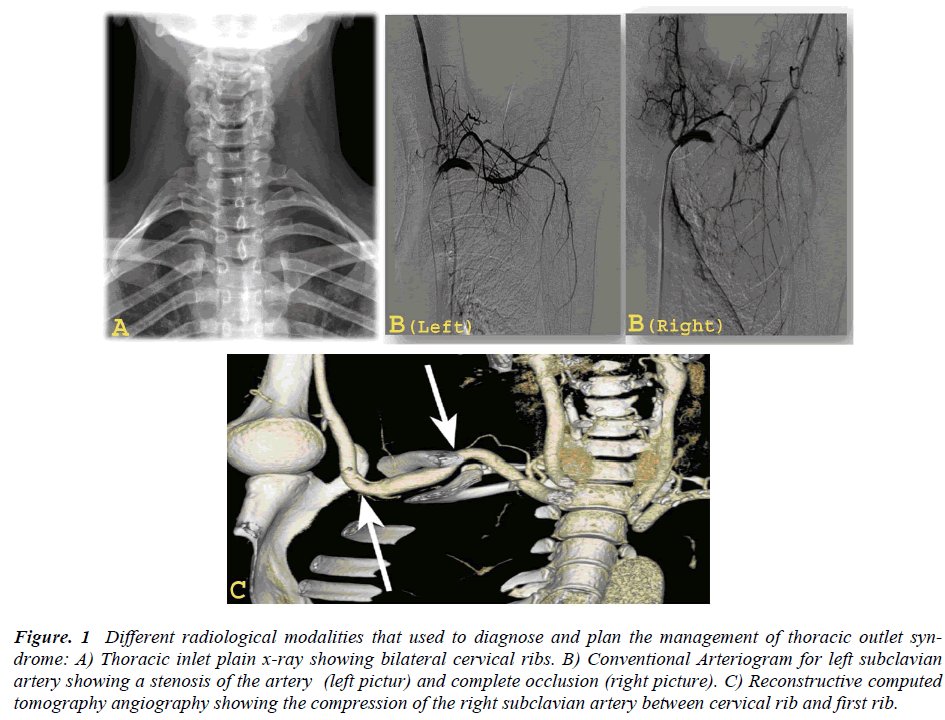 Vascular Thoracic Outlet Syndrome - ScienceDirect