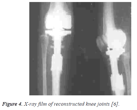 biomedres-reconstructed-knee-joints