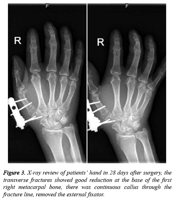 biomedres-removed-external-fixator