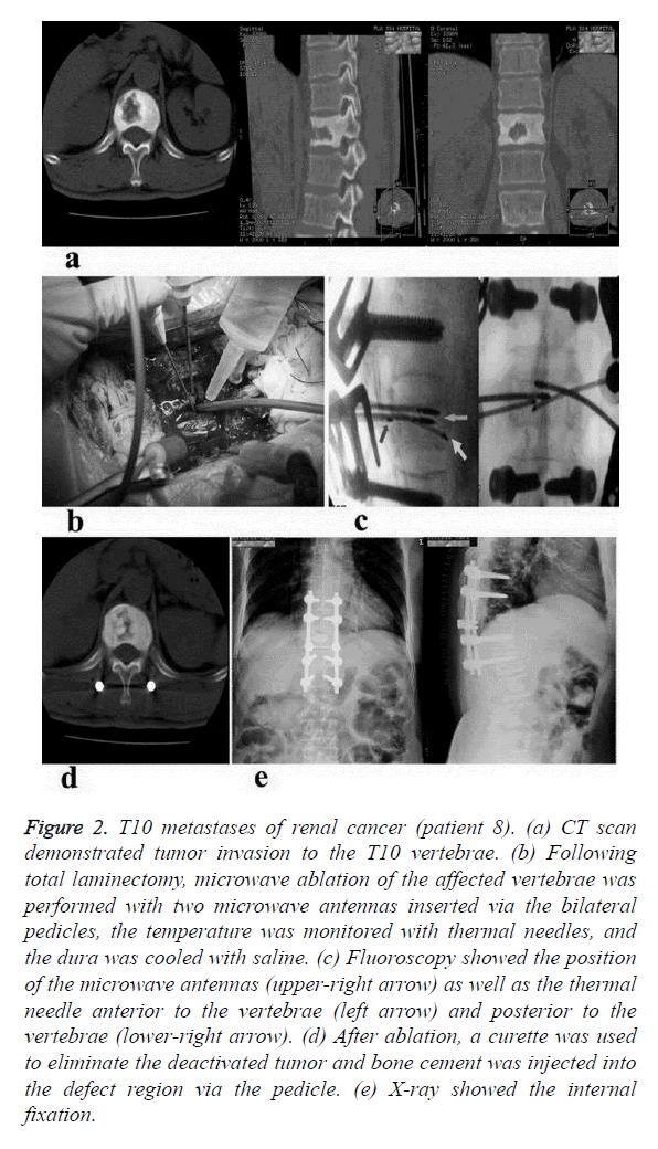 biomedres-renal-cancer