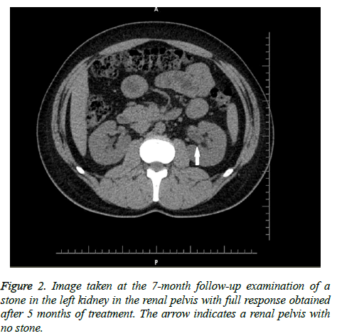 biomedres-renal-pelvis