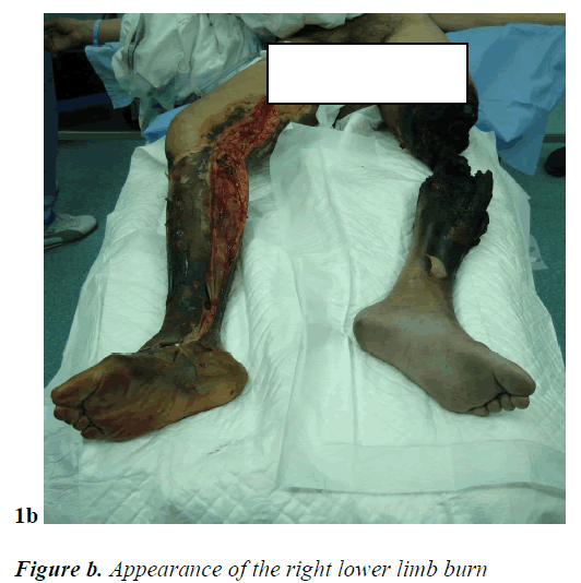 biomedres-right-lower-limb