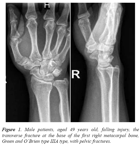 biomedres-right-metacarpal-bone