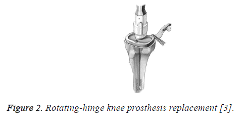 biomedres-rotating-hinge-knee