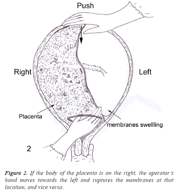 biomedres-ruptures-membranes