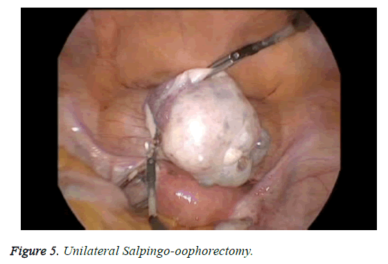 biomedres-salpingo-oophorectomy