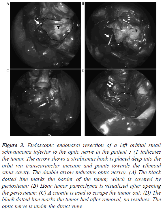 biomedres-schwannoma-inferior