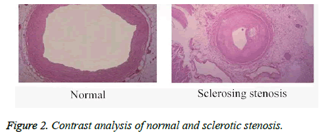 biomedres-sclerotic-stenosis