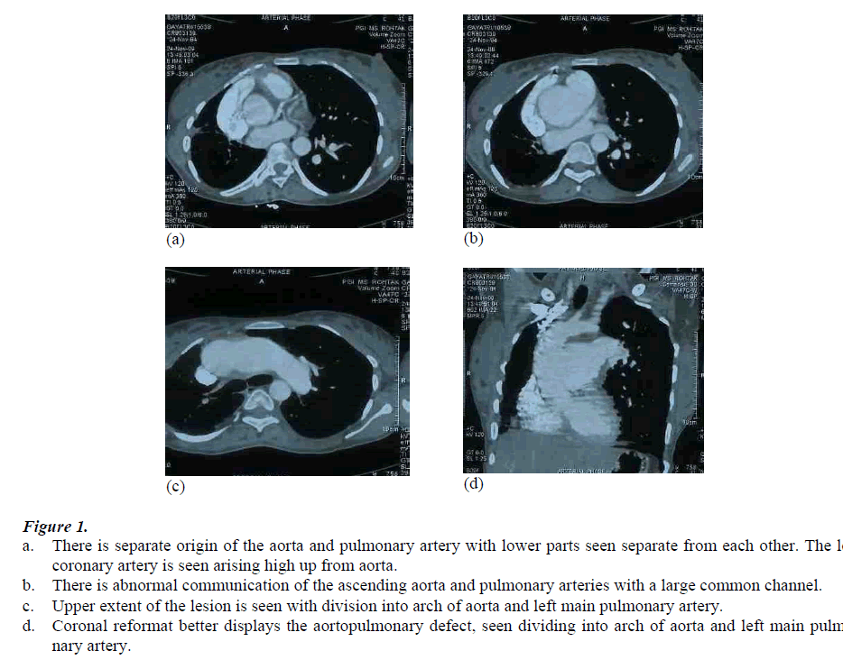 biomedres-separate-origin-aorta-pulmonary