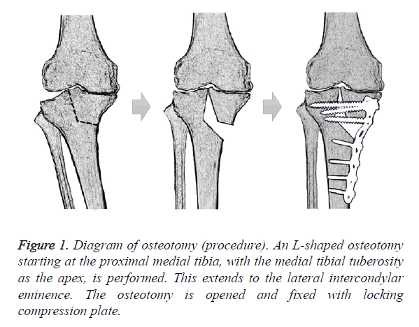 biomedres-shaped-osteotomy