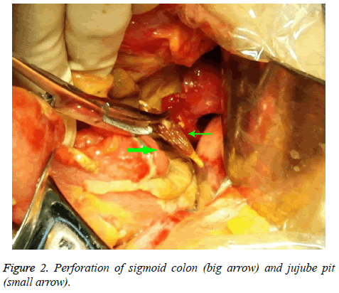 biomedres-sigmoid-colon