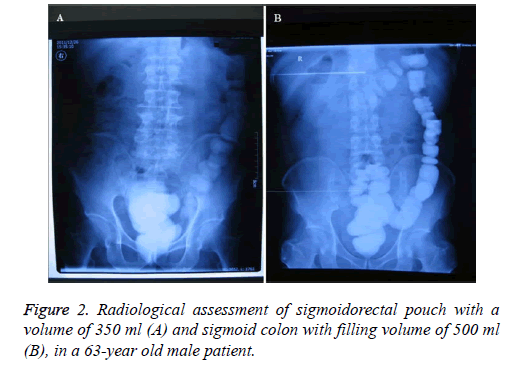 biomedres-sigmoidorectal-pouch