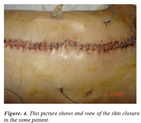 biomedres-skin-closure