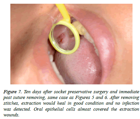 biomedres-socket-preservative